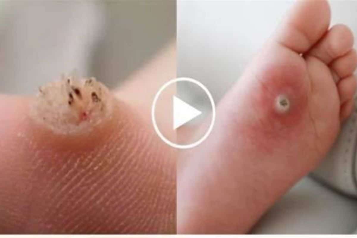 Tratamento Caseiro para Olho de Peixe